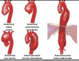 3_-ANEURISMA-AORTA1