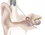 Cochlear_implant[1]