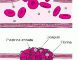 HEM_blood_clots_plugging_it[1]