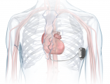 MDT-Aurora-EV-ICD-illustration-in-chest_low-res