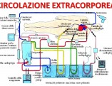 circolazione-extracorporea-esempio