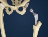 depositphotos_199877792-stock-video-hip-replacement-implant-installed-pelvis[1]