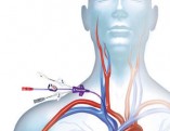 Central venous catheter / pressure monitoring
