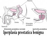 iperplasia-prostatica-benigna