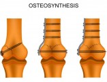 osteosintesi-procedura