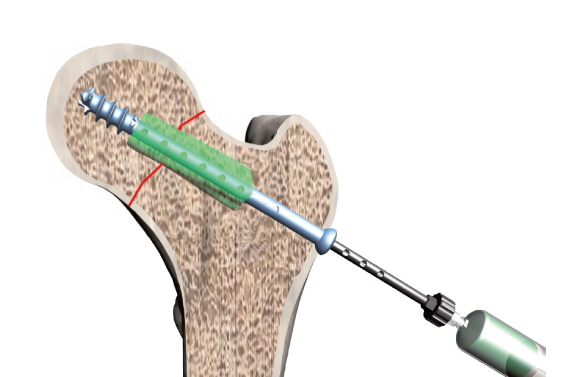 osteosintesi