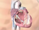 pacemaker-leadless-senza-fili-una-rivoluzione-tecnologica-in-cardiologia