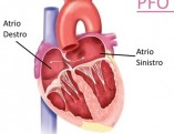 pfo-forame-ovale-previo-(1)-(2)[1]